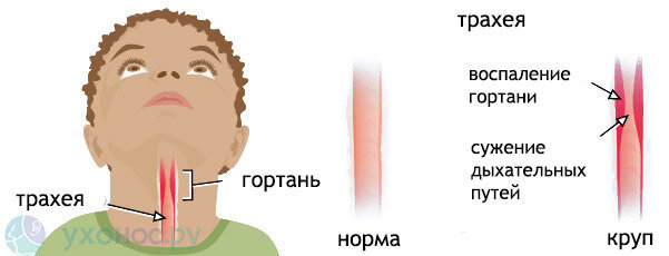 Ларингит у детей, что делать и как помочь?