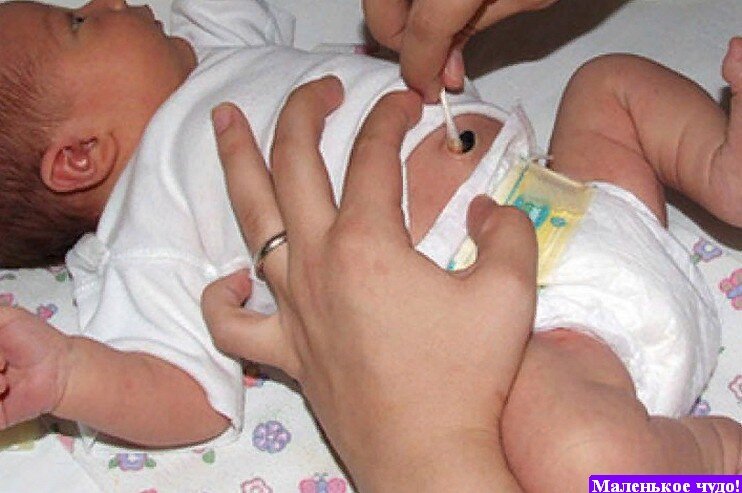 Флегмонозный омфалит у новорожденных. Как нужно обрабатывать пупок. Обработка пупочной ранк. Как нужно обрабатывать пупок. Обработка пупочной ранки у новорожденных алгоритм.