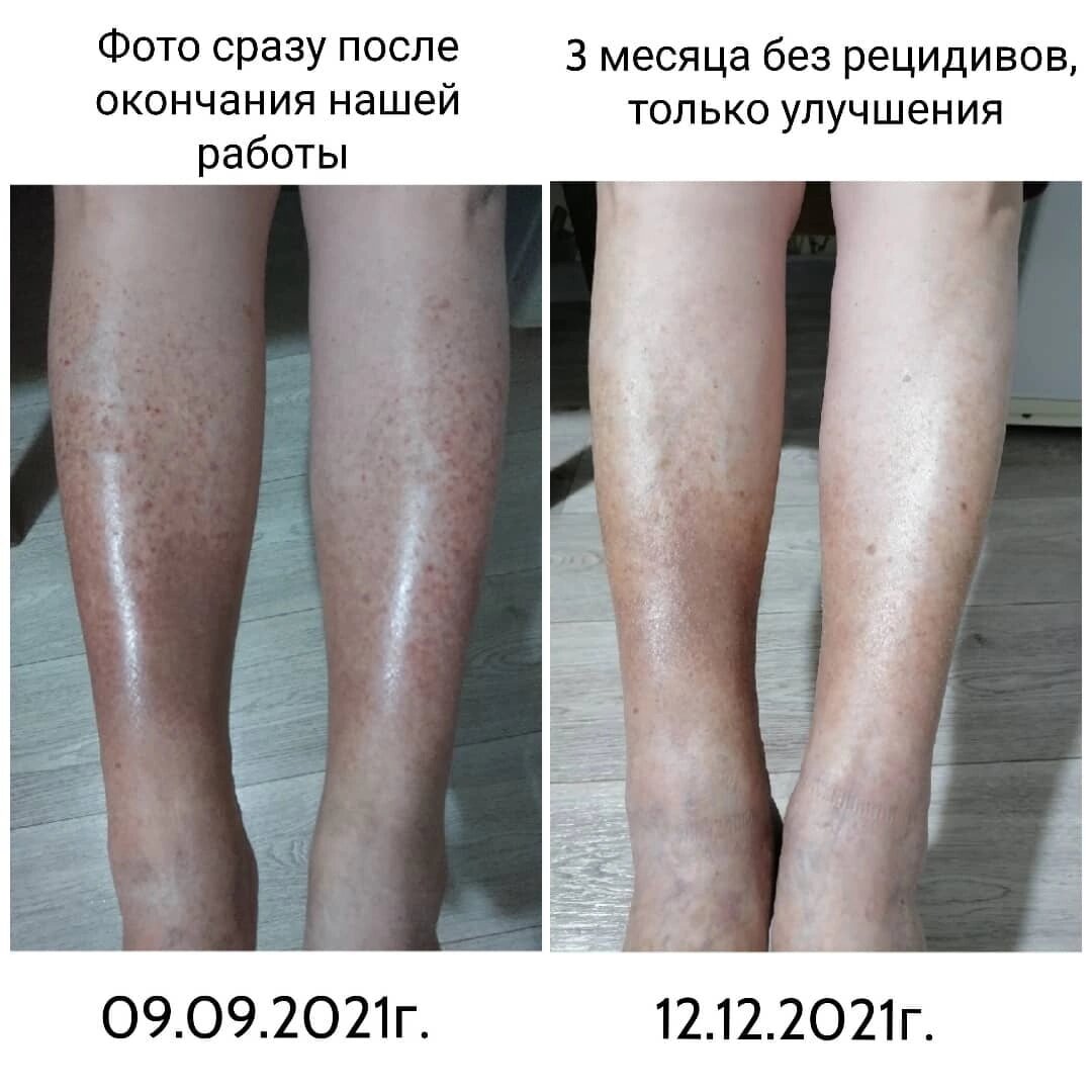 При острой фазе аллергии пятна ярко бордового цвета превращались в одно огромное пятно и такими "чистыми", как на фото После, за 5 лет ноги у мамы не были. 