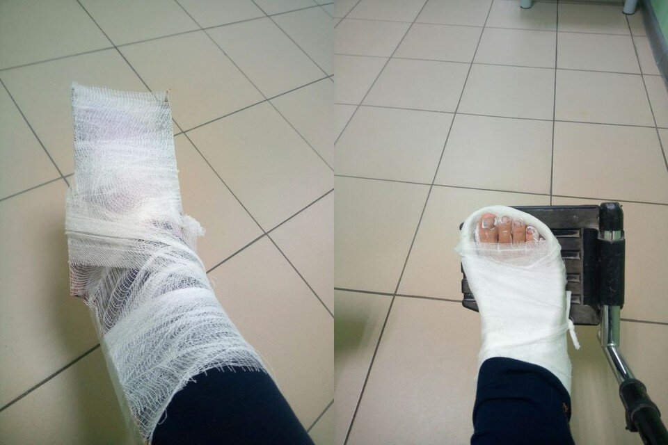     Гипс девочке наложили уже в другой больнице. Фото: Город Обь Онлайн