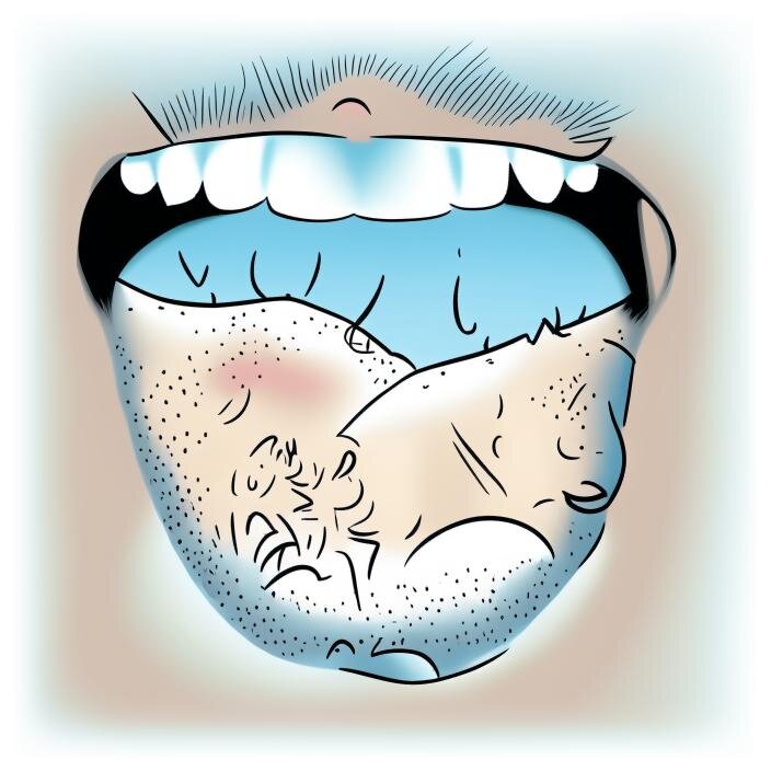 Ксеростомия (сухость в полости рта). Ксеростомия на красивом фоне.