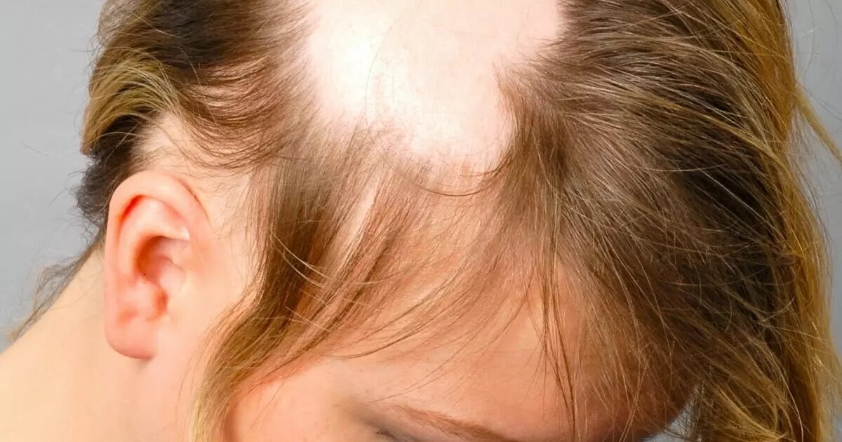 9 лет выпадают волосы. Очаговая алопеция офиазис. Очаговая (гнездная) алопеция. Трихофития волосистой части головы.