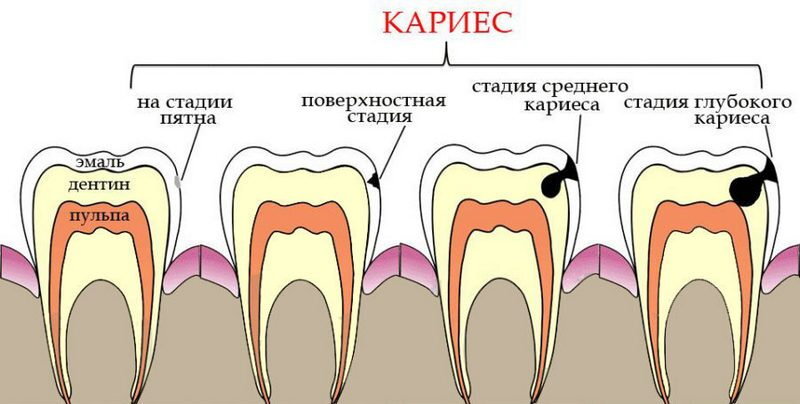 Кариес в стадии пятна - что это, лечение, диагностика, симптомы