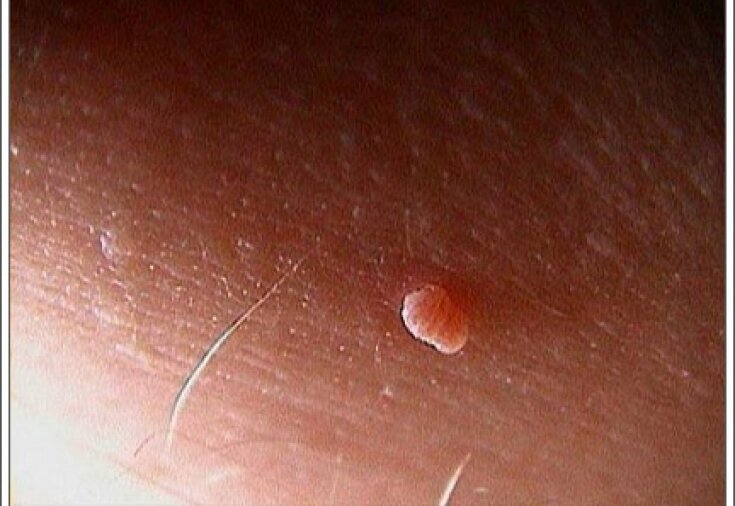 Папилломы человека: почему они возникают и как от них избавиться