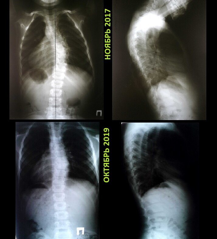 кифосколиоз грудного отдела позвоночника 2. остеопатический кифосколиоз. сколиоз грудного отдела позвоночника рентген. кифосколиоз 2 степени рентген. кифосколиоз грудного отдела позвоночника 4 степени.