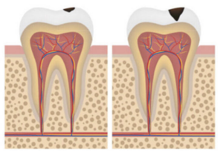 Кариес зубов 