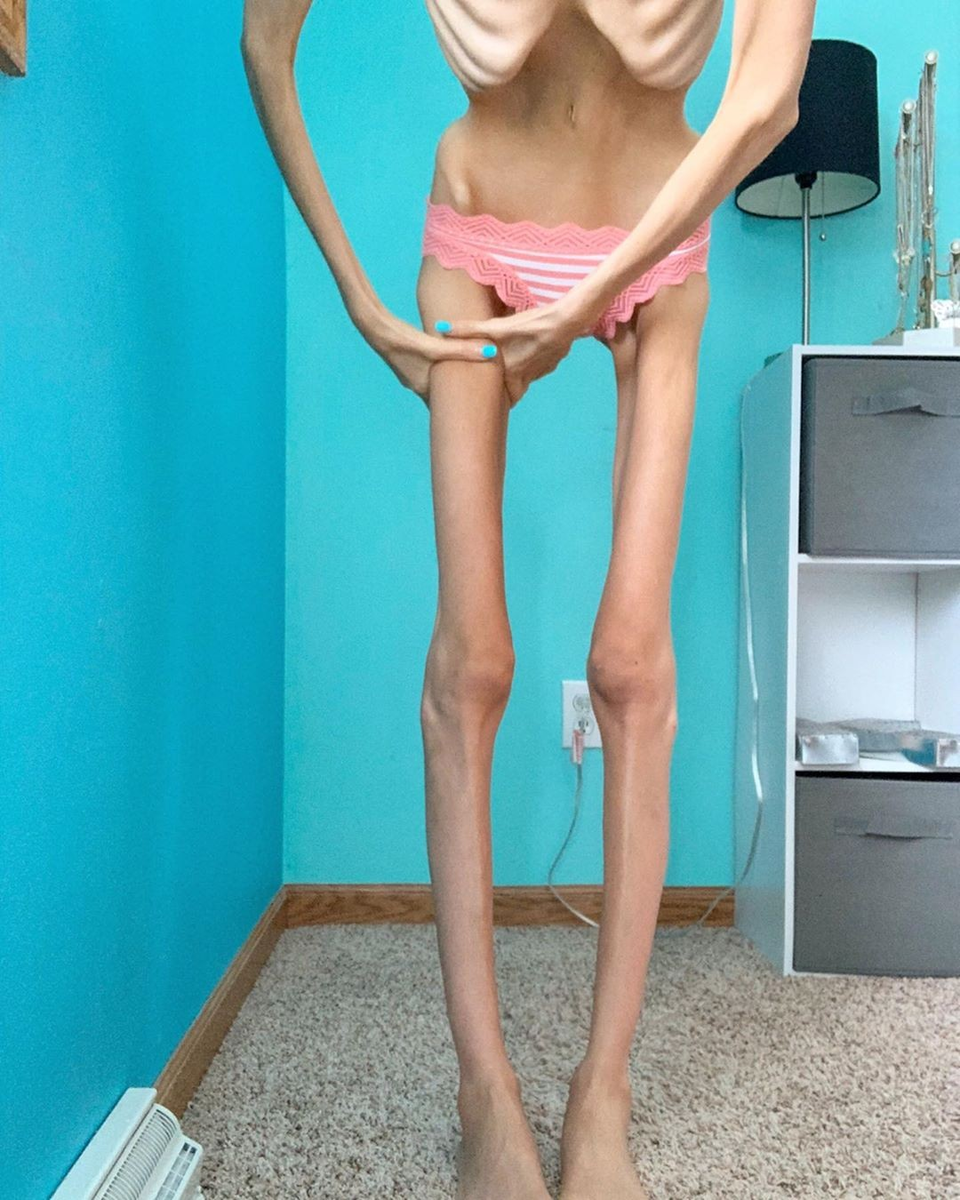 Anorexic only fans