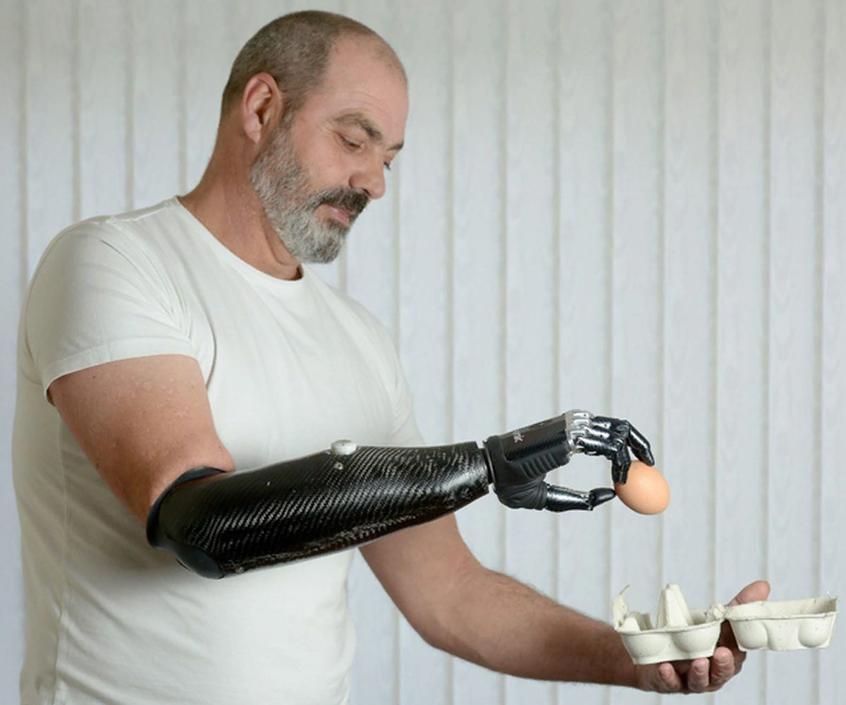 Самый дорогой протез. Бионические протезы bebionic. Найджел Экланд бионическая рука. Bebionic 3. Бионический протез руки bebionic.