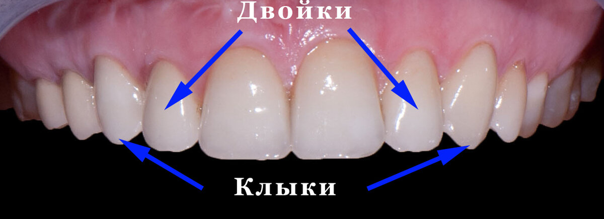 Что делать, если нет двух передних зубов