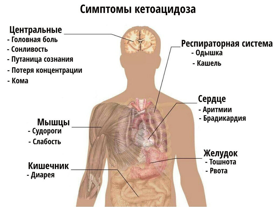 Тошнота дрожь в теле. Осложнения сахарного диабета кетоацидоз. Симптомы при кетоацидозе диабет 1 Тип. Клинические симптомы диабетического кетоацидоза. Кетоацидоз при сахарном диабете проявляется.