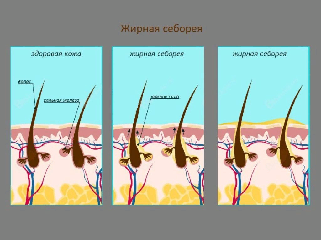 Усиление кожного рисунка