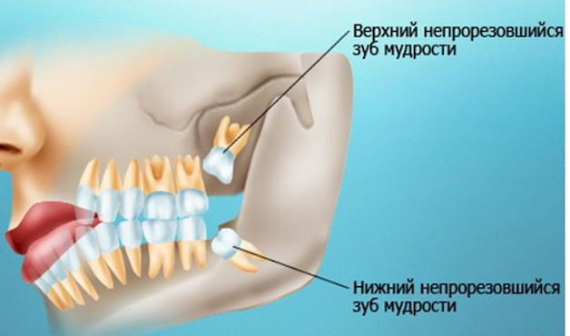 Зачем удалять зуб, если он не болит и никак не беспокоит? Обычно и правда незачем, но вот в случае с зубами мудрости могут быть причины. Рассказываем, как защитить себя от возможных проблем.