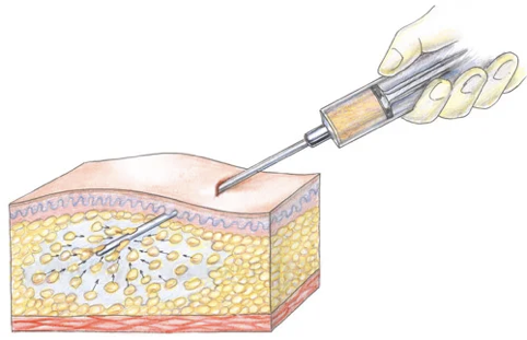 Забор жировой ткани с помощью канюли 