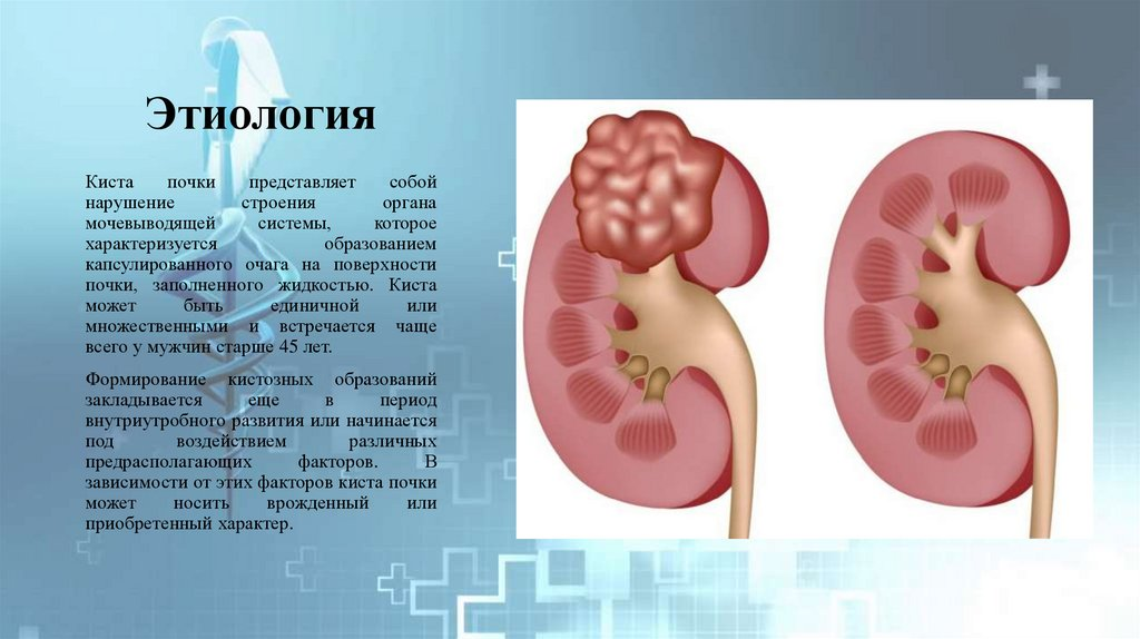 Боли при кисте почки. Кисты почек классификация.