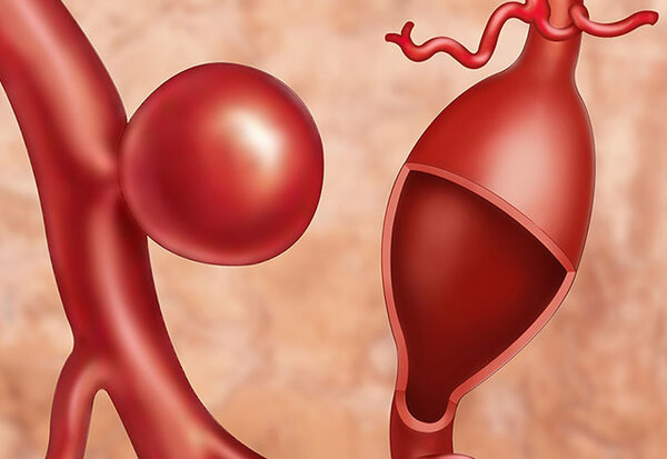 Медицинская визуализация аневризмы