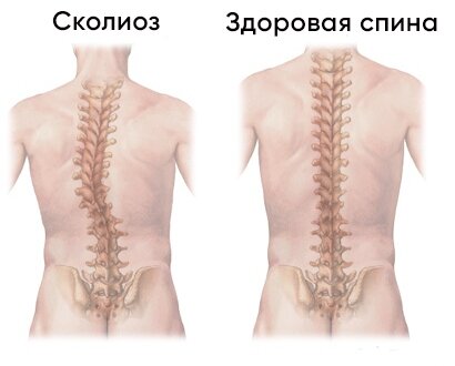 Сколиоз у детей и подростков