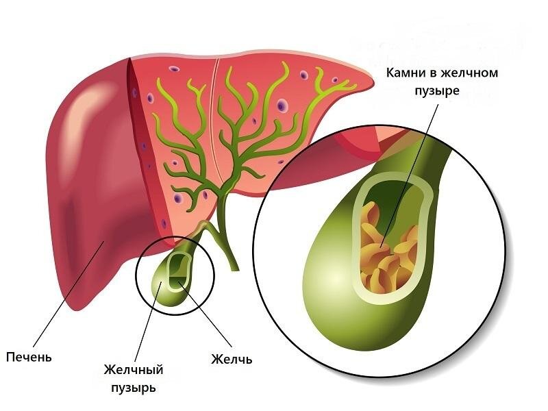 Желчнокаменная болезнь (ЖКБ): диагностика и лечение | Клиника Семейный доктор