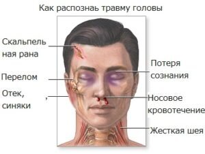 Лечение ушибов головного мозга