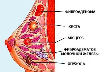 Фурункул на интимном месте - симптомы и лечение у женщин