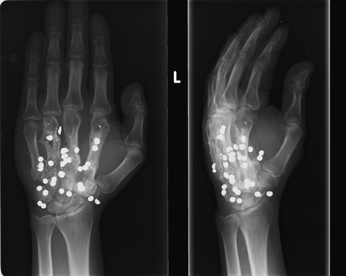 Ранение от дробовика.