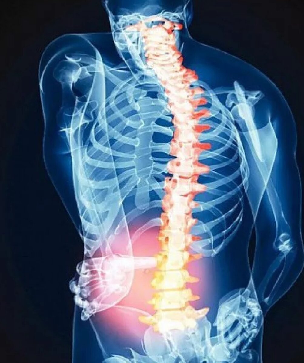 Что делать? грыжи ,протрузия.