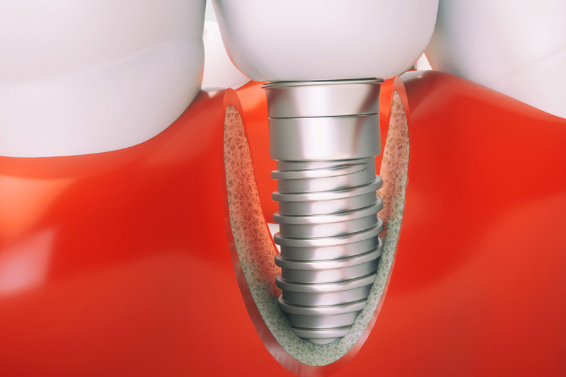Имплантат зуба что это такое фото