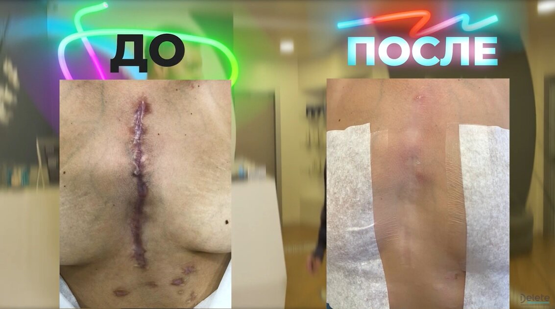 Удаления сложных рубцов