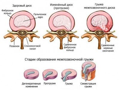 Йога. 5 лечебных поз при грыже диска нижнего отдела позвоночника