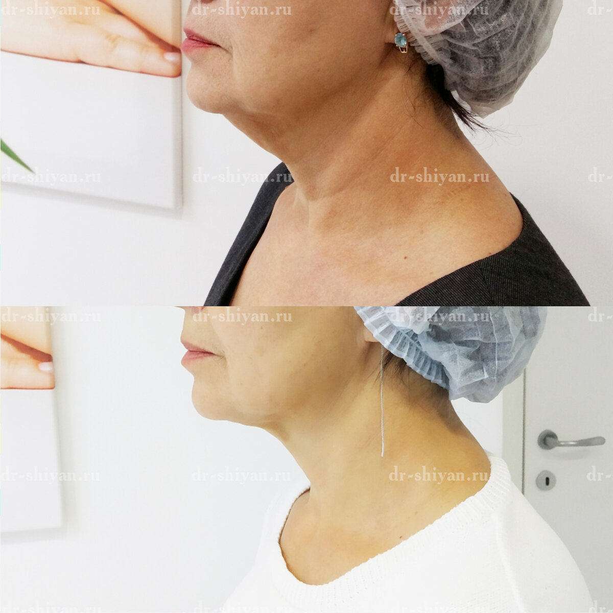 Подбородочная область. Нитевой лифтинг - До и После