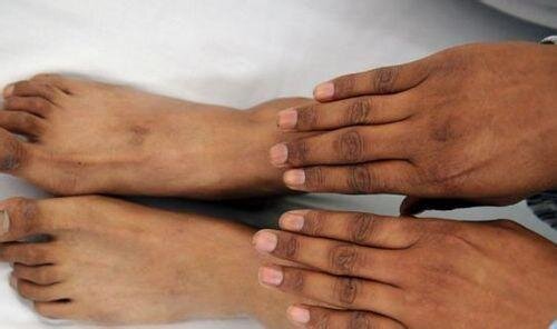 Начало болезни Аддисона, появление темных пятен