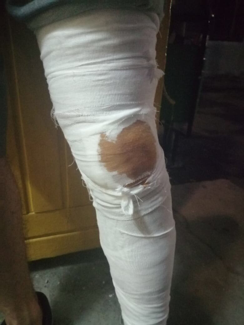 Травма еще свежая