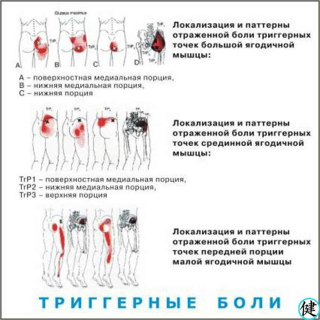 Боль отдает в пах. Локализация боли в ягодицах. Триггерные точки ягодичной мышцы. Триггерные точки на ягодицах. Локализация болей схема.