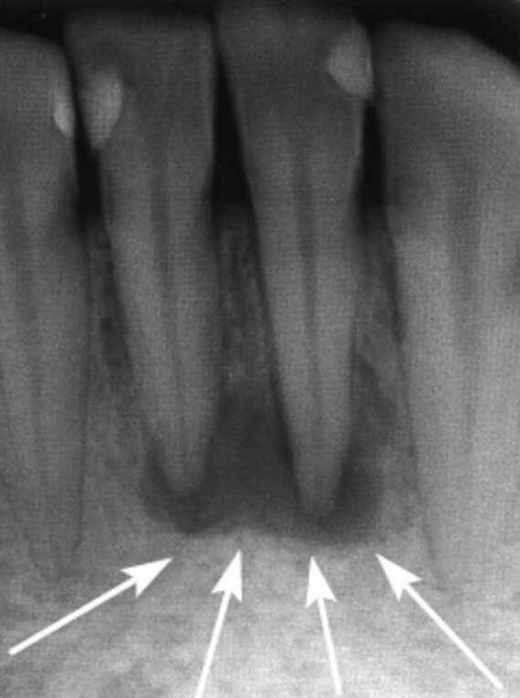 Затемнение над основанием корня на рентген-снимке 
