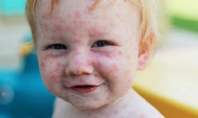 Краснуха. фото из индекс картинок для наглядности.