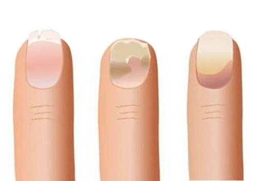 Грибок ногтей на руках