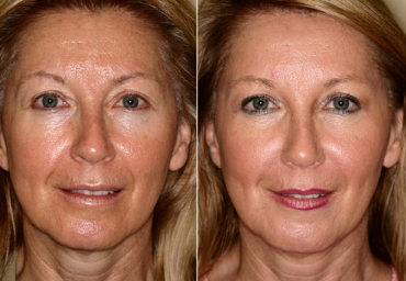 пример ДО и ПОСЛЕ (картинка принадлежит клинике лаборатория красоты Полины Цукановой)