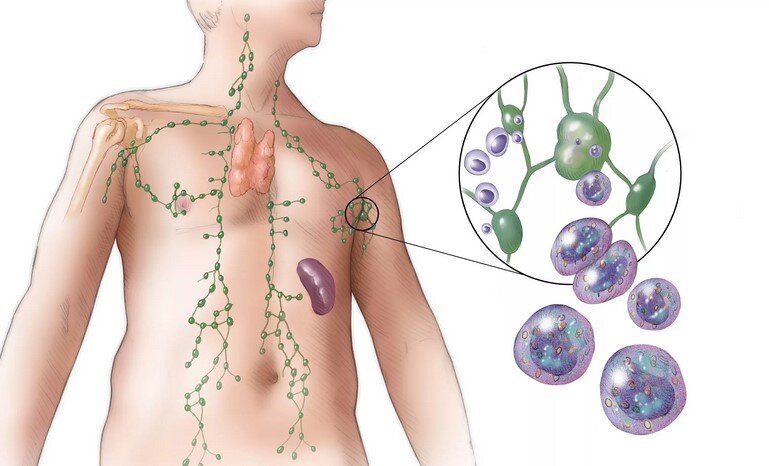 Лимфома Ходжкина: симптомы, признаки, лечение, прогноз