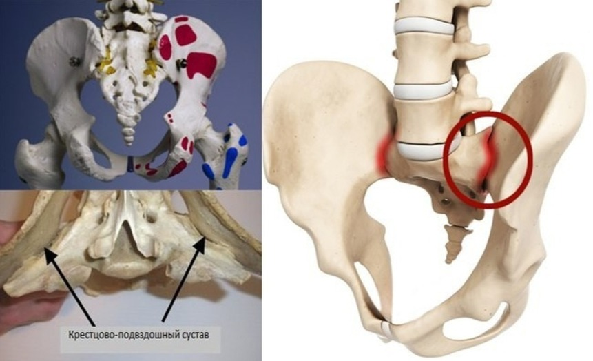 Сакроилеит крестцово-подвздошного. КПС сустав крестцово-подвздошный. Сакроилеит крестцово-подвздошного сочленения симптомы.
