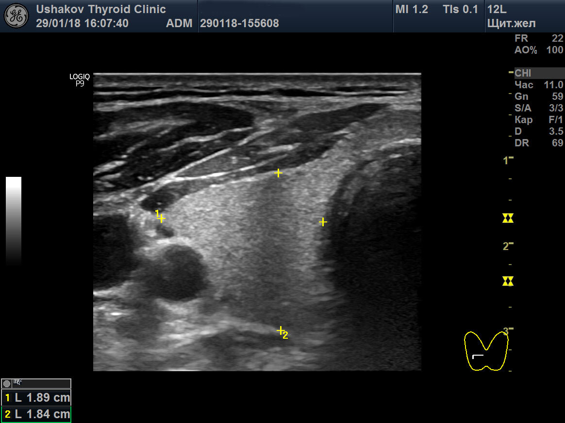 Ультразвуковое исследование паращитовидной железы. УЗИ паращитовидных желез. Паращитовидные железы на УЗИ. Острый тиреоидит щитовидной железы на УЗИ.