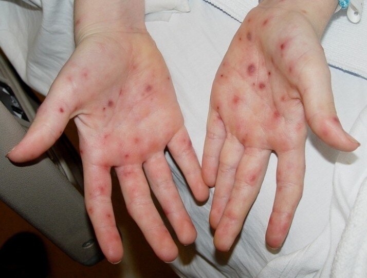 Виды дерматита, причины возникновения и общие симптомы | Балтмед