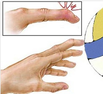 Разрыв сухожилия пальца: лечение, симптомы и причины заболевания