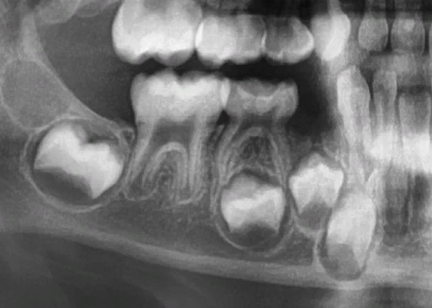 На этом рентгеновском снимке челюсти ребенка видно, как плотно в ней располагаются молочные зубы и зачатки постоянных.