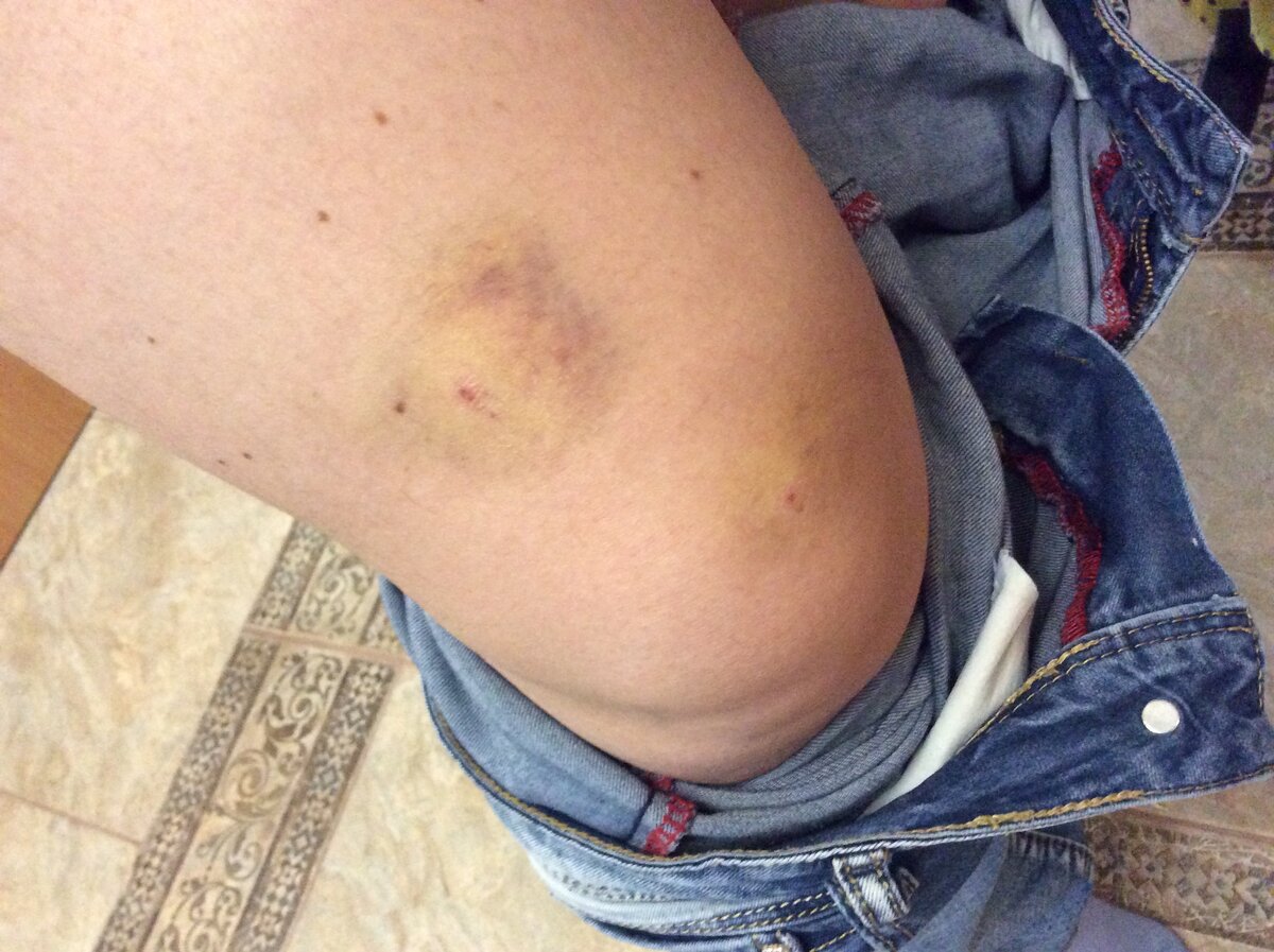 След укуса «доброй» собаки