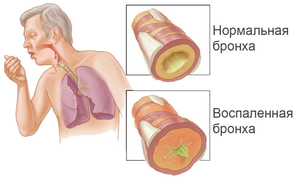 Бронхит у взрослых: как развивается и при каких симптомах требуется лечение