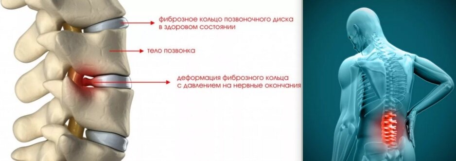 Заболела спина и «стреляет» в пояснице