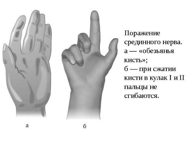 Немеют или болят руки?