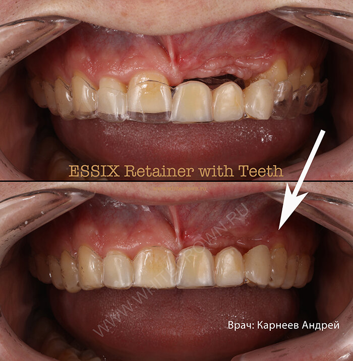 Каппа ESSIX Retainer