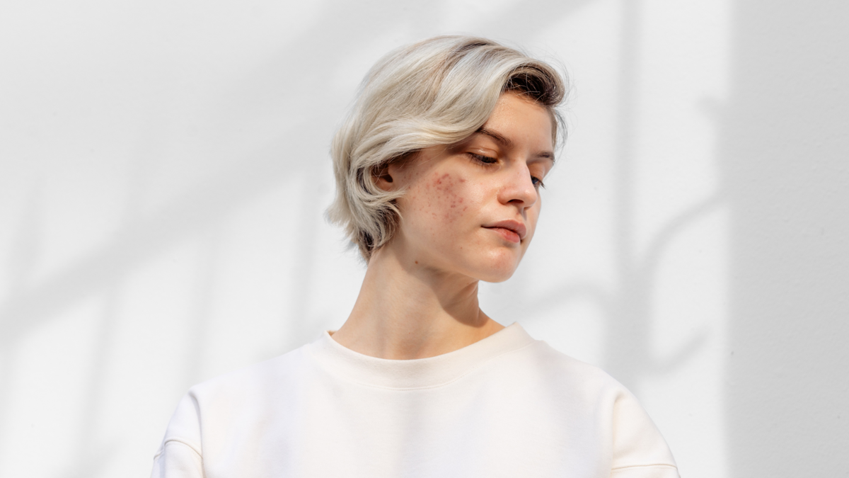 Ася Попова, не стесняется акне