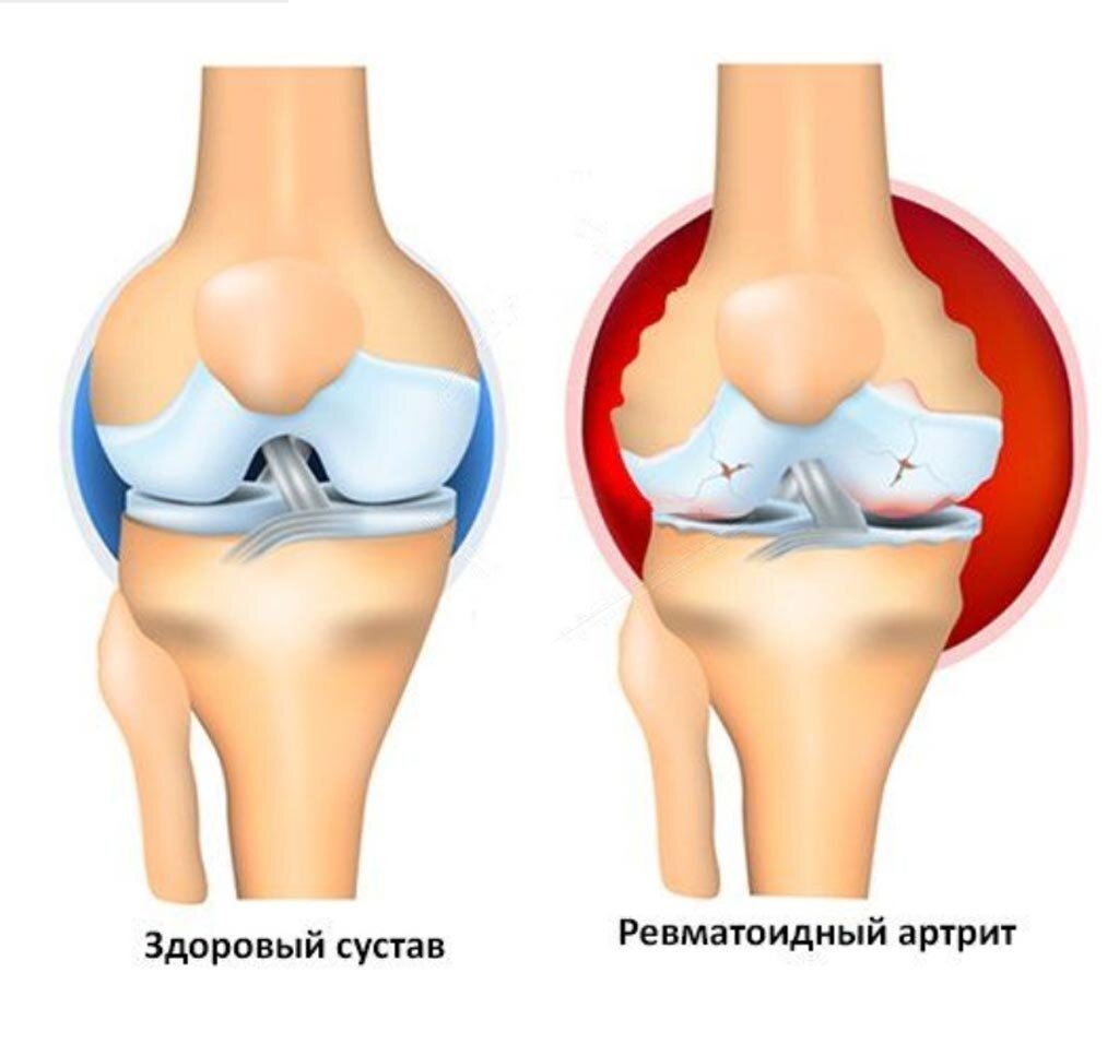 Ювенильный артрит коленного сустава. Ювенильный ревматоидный артрит коленного сустава. Системный ювенильный ревматоидный артрит. Ювенильный артрит колено.