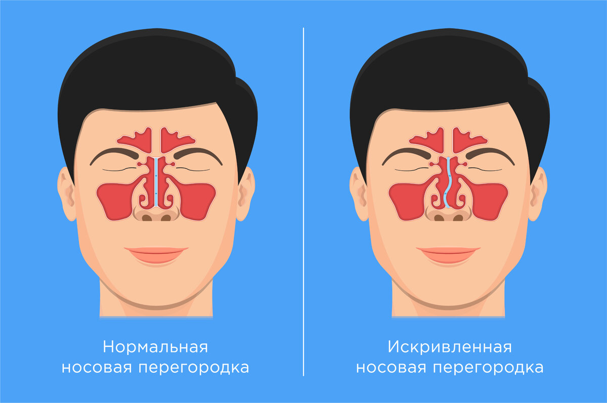 Современные методы реабилитации после септопластики